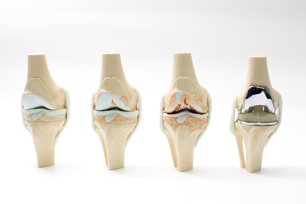 Total Knee
                Replacement vs. Microplasty: Which is Right for You?